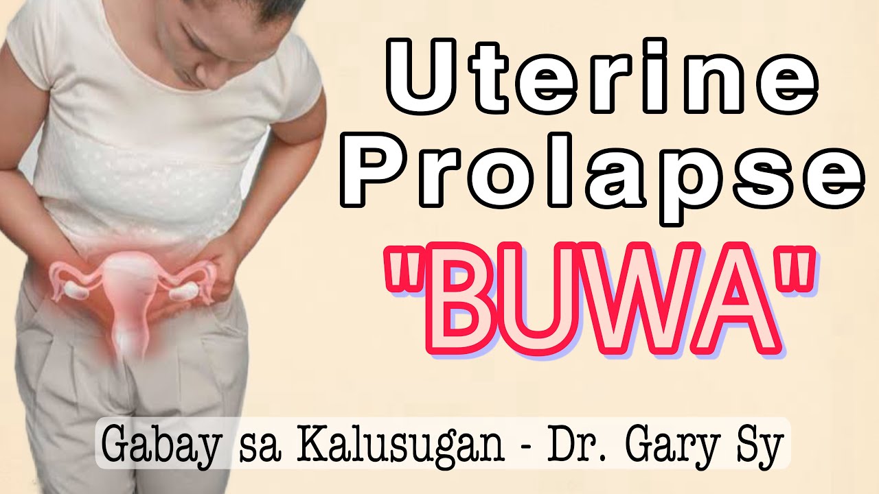 Uterine Prolapse (BUWA) - Dr. Gary Sy