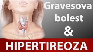 Razumijevanje hipertireoze i Gravesove bolesti Dr#49