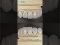 pfm crown vs zirconia. #dentist #dentalclinic #china