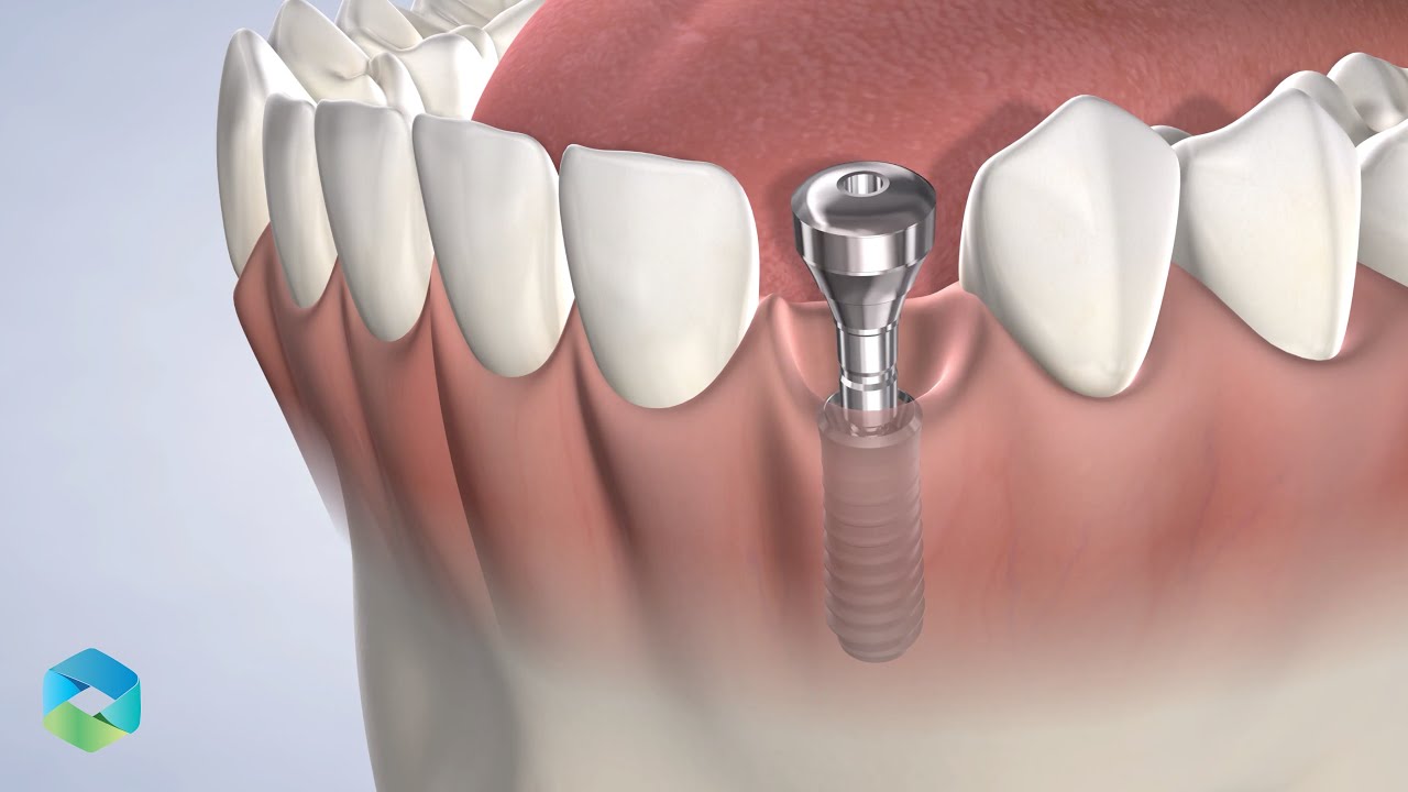 Dental Implants in Mount Pleasant SC Oral Surgery & Dental Implant
