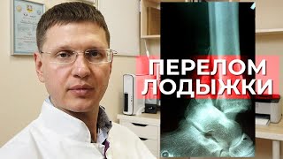 Как лечить перелом лодыжек? Профилактика тромбоэмболий