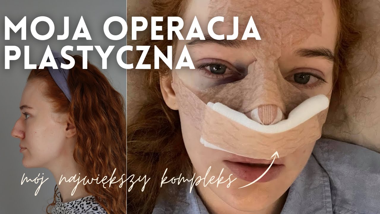 OPERACJA NOSA (CKN) | Wszystko o operacji, vlog dzień po dniu