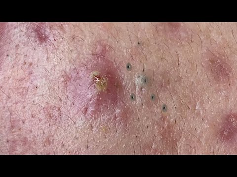 Sneak Peak Cyst And Blackhead Popping Videos Track - h0o07a9
