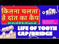 कितना चलता है दांत का कैप-Life of dental crown/bridge -कैसे बढ़ाये टूथ कैप  की लाइफ-Dr.Praveen Bhatia