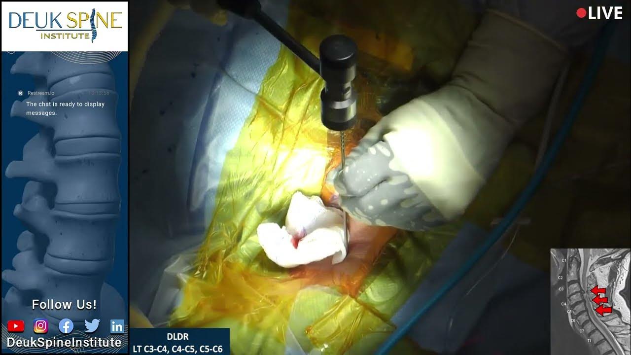Watch Live Spine Surgery! Deuk Laser Disc Repair LT C3C4, C4C5, C5C6