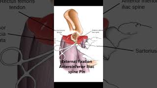 Pelvis external fixation Anteroinferior Iliac spine pin placement