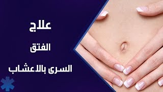 علاج الفتق السري بالأعشاب