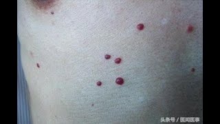 驚!身上突然長出小紅痣,難道是身體出問題了嗎?快看看是怎麼回事? | 新闻24小时