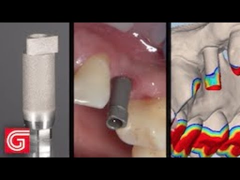 Tips for Submitting Digital Impressions of an Implant Scan Body to the Laboratory