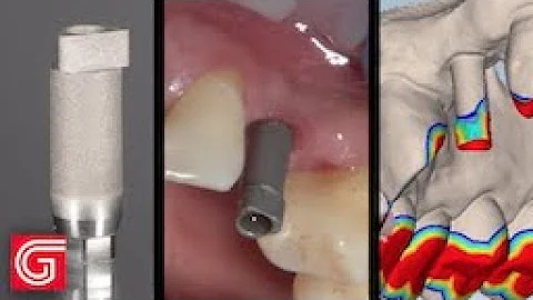 Tips for Submitting Digital Impressions of an Implant Scan Body to the Laboratory