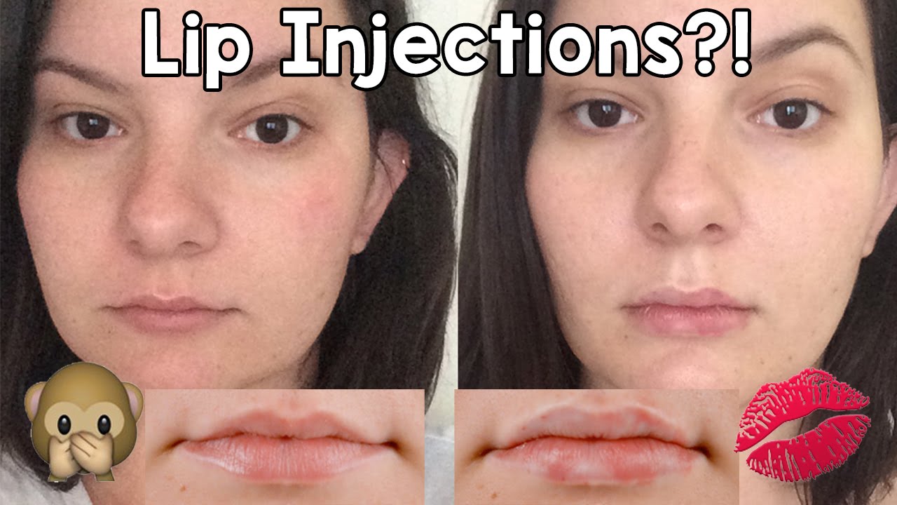 My Lip Injection Experience! Restylane Silk Before & After ...