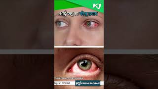 Eye Flu से निजात पाने का घरेलू उपाय | आई फ्लू इलाज | Conjunctivitis - Cause, Prevention & Treatment