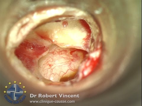 Transcanal myringoplasty with total tympanomeatal flap removal for tympanic membrane perforation