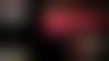 Distal tibial non unions: Dr. S. Gawhale