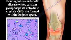 Gout and Pseudogout, Joint Pain- Everything You Need To Know- Dr. Nabil Ebraheim