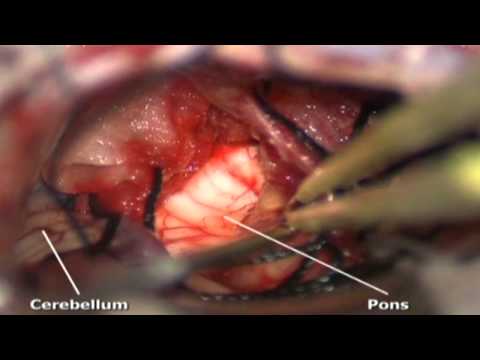 Please be advised that this video contains graphic footage of surgery. Translabyrinthine approach fo. 