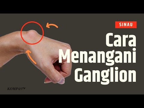 Video: Mengapa ganglion kembali?