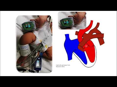 Video: ¿Qué son las saturaciones de oxígeno pre y posductal?