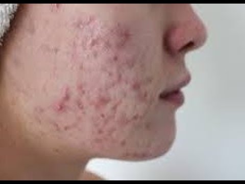 Как избавиться от прыщей? Чем заменить Зинерит?