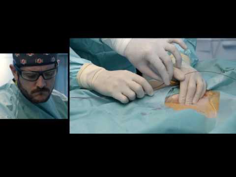 Vídeo: Trombectomia - Tipos De Cirurgia, Indicações, Resultados