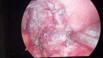 Laparoscopic appendectomy in subhepatic appendix