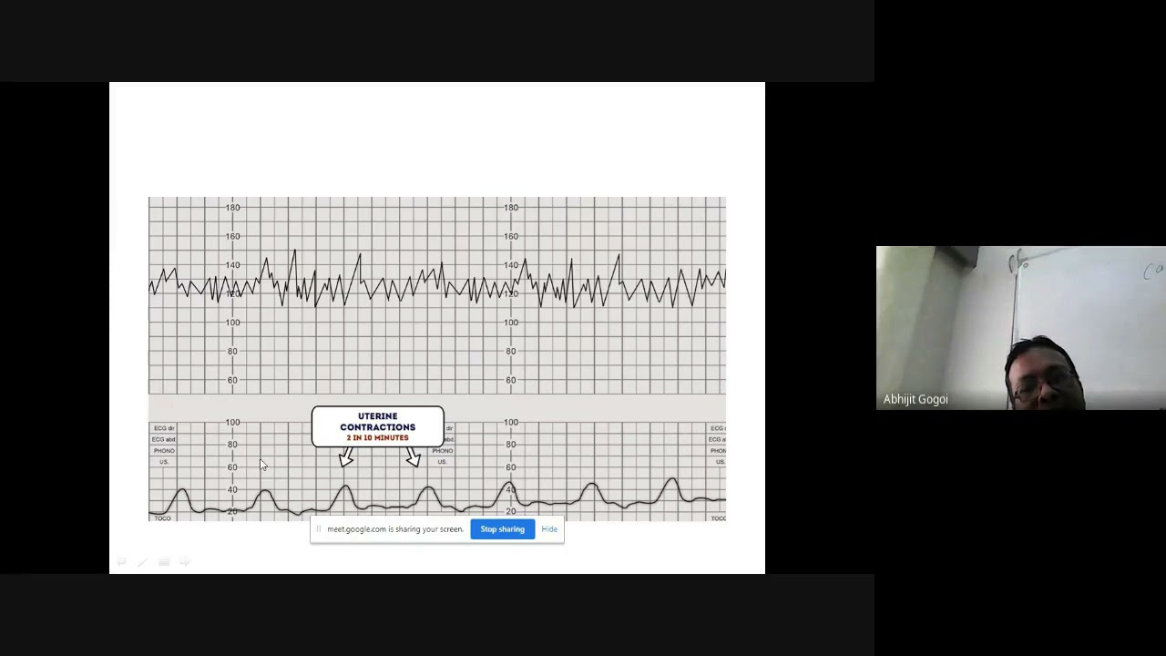cardiotocography