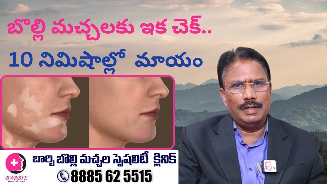 బొల్లి మచ్చలకు ఇక చెక్..10 నిమిషాల్లో మాయం | Micro-Pigmentation Treatment for Vitiligo | Dr M.N.Rao