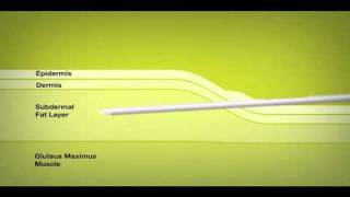 Testopel Testosterone Replacement Option