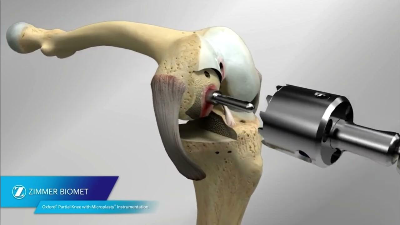 Oxford Partial Knee with Microplasty Instrumentation Animation - YouTube