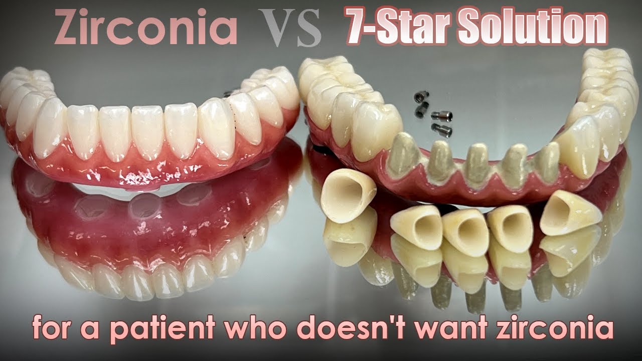 7-Star for a Patient That Doesn't Want Zirconia Implants