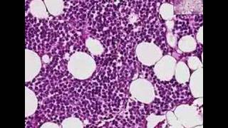 Histopathology Bone--Multiple myeloma