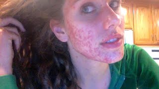 Beauty Blogger's Acne Transformation