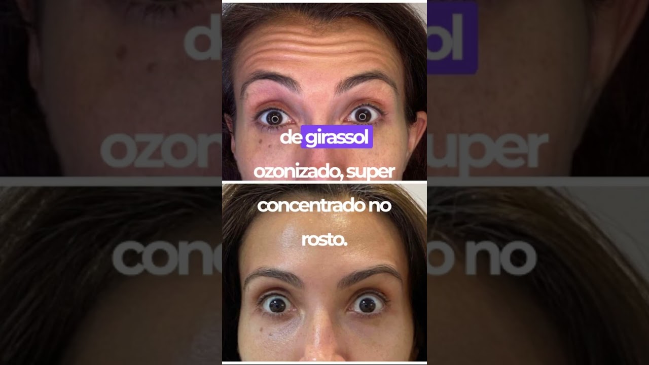 Antes e depois, de usar o óleo de Girassol ozonizado 