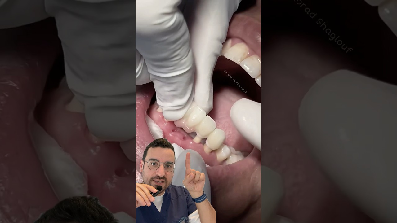 Bridge antérieur céramique : et si on refaisait aussi la gencive ?