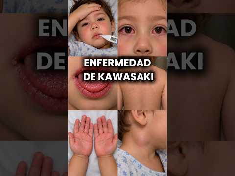 6 señales visibles de la enfermedad de Kawasaki en niños. #dermatologia #dermatologo #medicina
