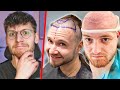 Haartransplantation gefhrlicher hype bei youtubern