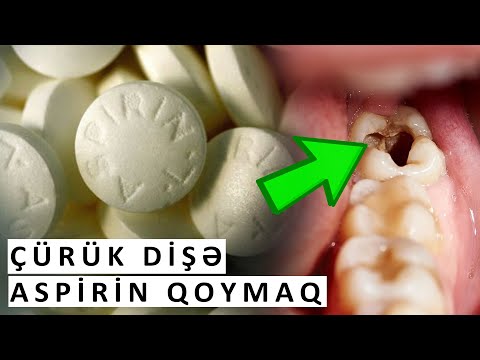 Aspirin çürük dişi müalicə edirmi? - İZLƏYİN