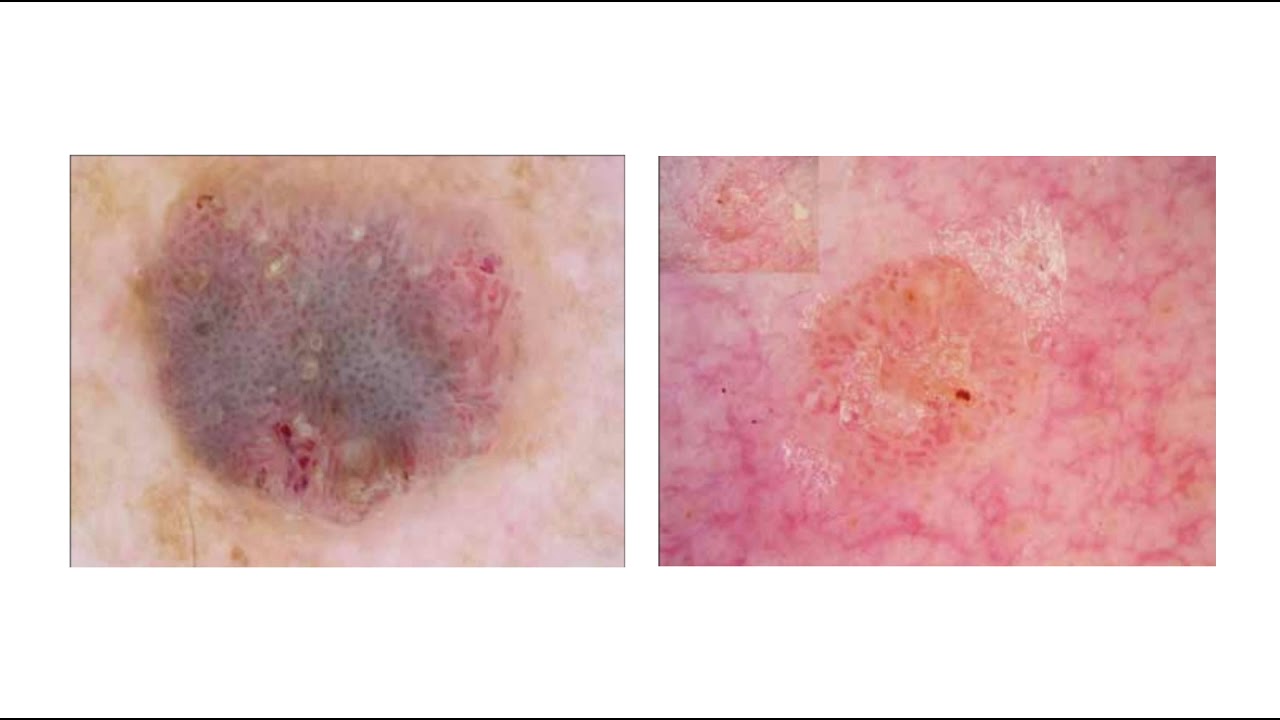 Tema 9 Dermatoscopia de la queratosis seborreica - YouTube