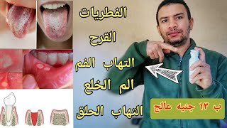 ب ١٣ جنيه فقط تخلصك من قرح و فطريات الفم و التهاب الحلق و اللثه و الم الضرس المخلوع خلال يومين