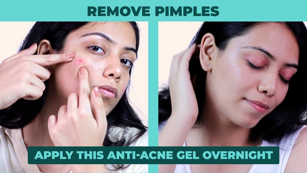 How to make your acne disappear overnight I antiacne gel remedies for