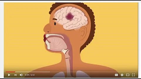 Swallowing and Communication after Stroke - DayDayNews