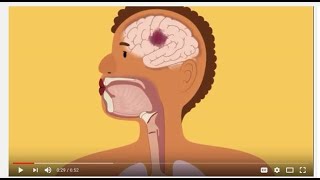 Swallowing and Communication after Stroke