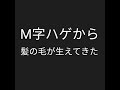 Ｍ字ハゲからフサフサになった。１日で抜けなくなります概要欄の最新動画参考