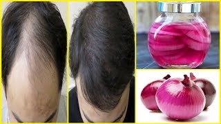 सिर्फ 21 दिनों में प्याज के रस से बालों को Regrowth करे | Onion Juice For Hair Loss & Hair Regrowth