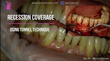 Recession Coverage Tunnel Technique with Connective Tissue Graft (Short Version)