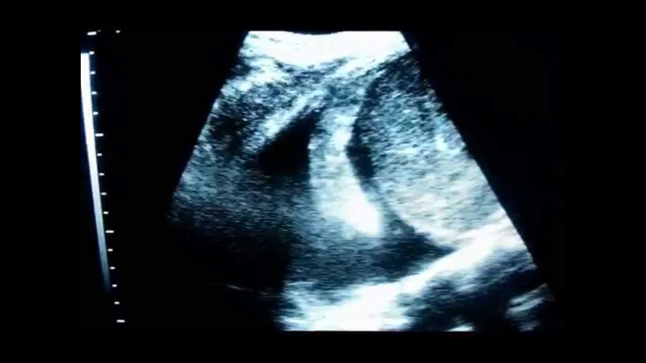 Ultrasound diagnosis of hemothorax YouTube