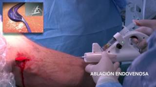 (vela) ablación endovenosa con láser