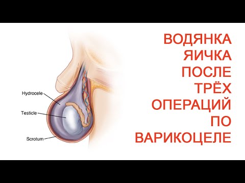 Водянка яичка после трех операций по варикоцеле / Доктор Черепанов