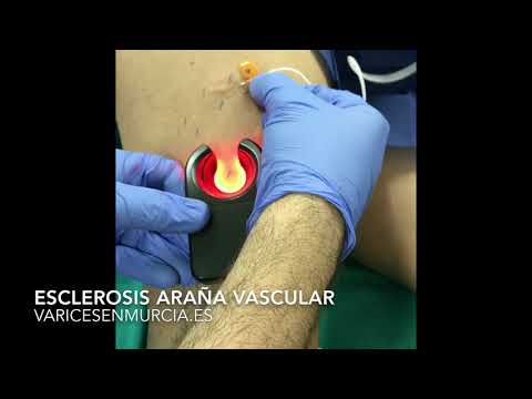 Esclerosis Araña Vascular