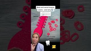 Best Braces Colors-Hot Pink Before And After